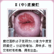 中度宫颈糜烂症状