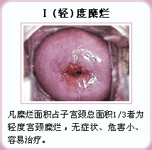 轻度宫颈糜烂症状