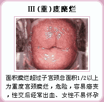 重度宫颈糜烂症状