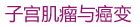 子宫肌瘤与癌变