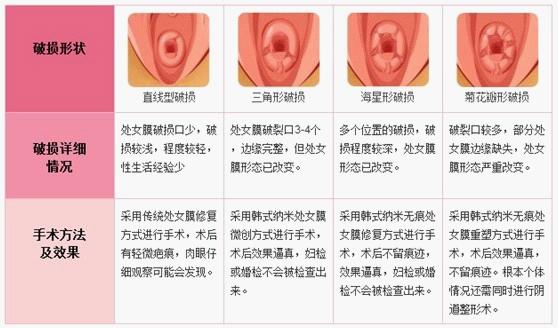 Venus处女膜真实重塑术