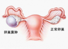 治疗卵巢囊肿的手术价格