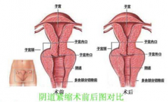 宿州哪家医院做阴道紧缩术好