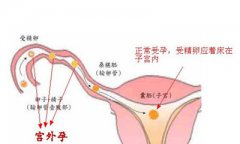 宫外孕手术大概多少钱?