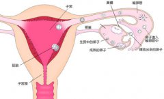 多囊卵巢综合症的症状有哪些?